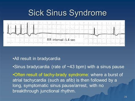 Sick sinus syndrome - lomicharge