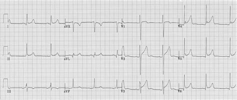 Acute Pericarditis ECG Changes