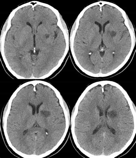 subacute infarct