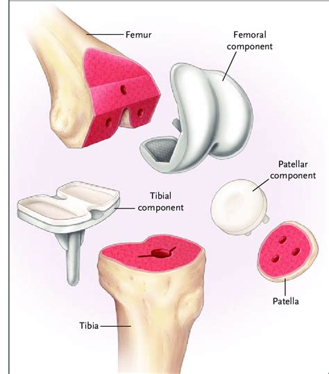 Components of Total Knee Arthroplasty. Precise resections are made in ...