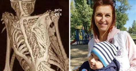 Boy, 2, turning into ‘living stone statue’ as his bones fuse due to 1 in 7 million disease ...