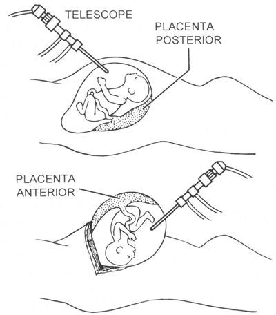 Techniques of Fetal Intervention