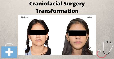 Craniofacial Surgery - Benefits, Techniques, Conditions & Techniques | Surgery, Bone grafting ...