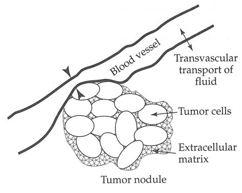 9: Proposed mechanism of Interstitial Fluid Pressure elevation. Tumor... | Download Scientific ...