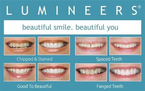 Lumineers Teeth Before And After