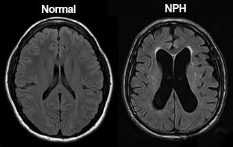 Ayurvedic Treatment of Normal Pressure Hydrocephalus (NPH), Herbal Remedies - Causes, Symptoms