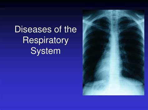 PPT - Diseases of the Respiratory System PowerPoint Presentation, free ...