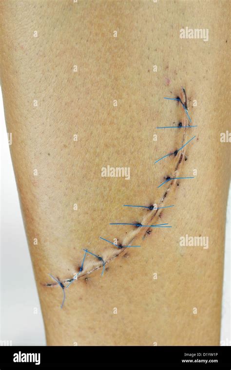 Leg stitches hi-res stock photography and images - Alamy