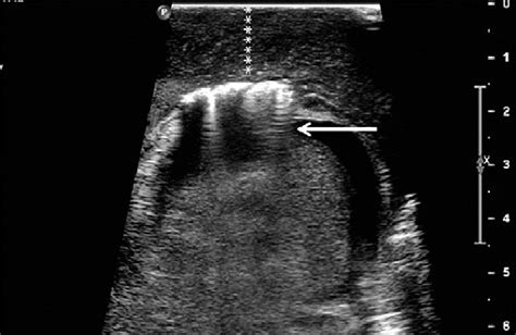 Transverse ultrasound of the left hemiscrotum reveals reverberation... | Download Scientific Diagram