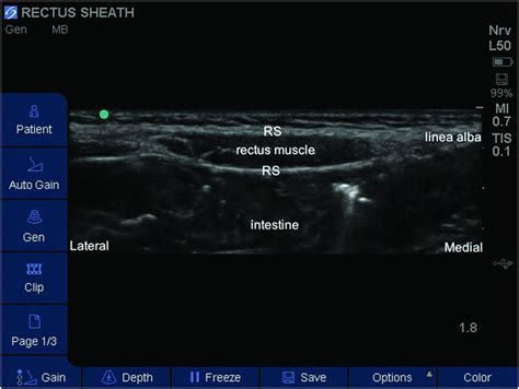 Ultrasound-guided rectus sheath block | Anesthesia Key