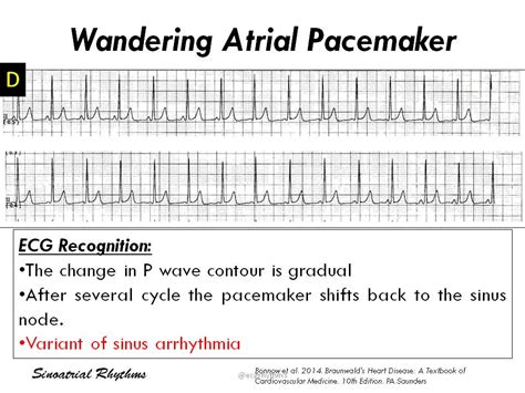 wandering atrial pacemaker ecg - Captions Editor