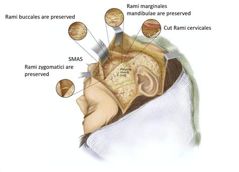 Neurectomy, Myotomy and Myectomy | Fazialis