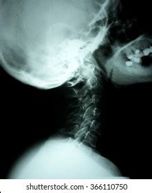 1,213 Broken Neck Xray Images, Stock Photos & Vectors | Shutterstock