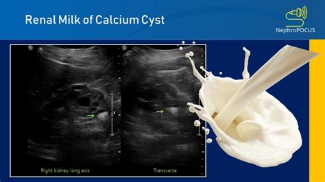 Renal milk of calcium cysts – NephroPOCUS