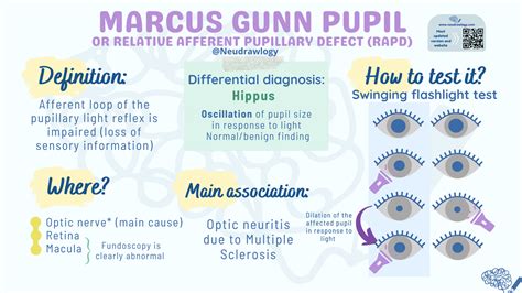 Marcus-Gunn pupil — Neudrawlogy: Simplifying Neurology