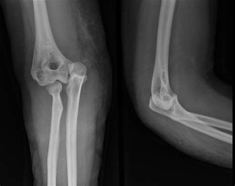 ELBOW DISLOCATION | buyxraysonline