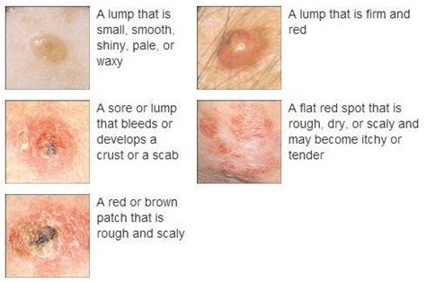 skin colored bump on face - pictures, photos