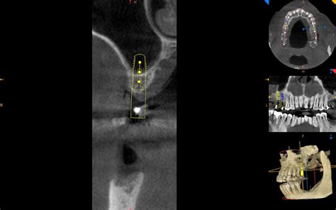 Sinus Lift and Onlay Bone Graft to Restore Height and Width of Bone for Upper Dental Implants ...