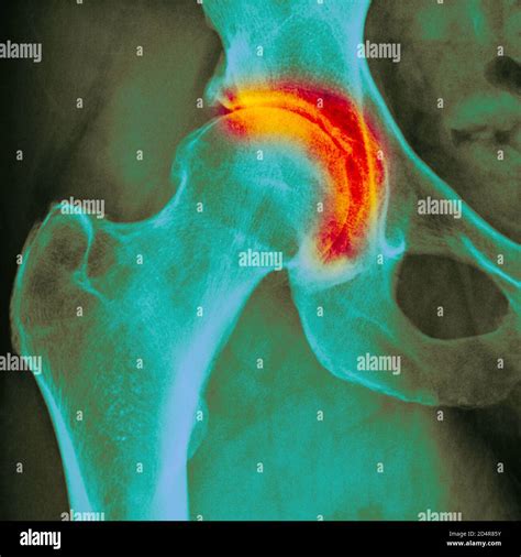 X-ray showing arthritis of the hip, arthritis is a joint disease that ...