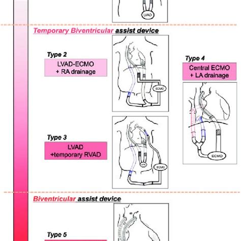 Types and selection of central ventricular assist device... | Download ...