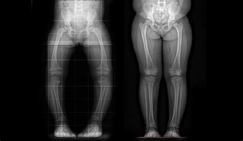 Burosumab Trial Provides Breakthrough in Rare Bone Disease - Vanderbilt ...