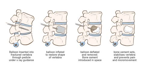 Balloon Kyphoplasty - Rajiv Bajekal