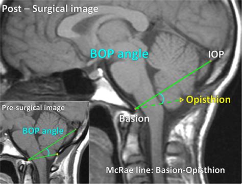 Internal Occipital Protuberance Mri