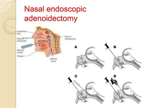 ADENOIDS&ADENOIDECTOMY BY ROOHIA