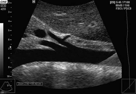 Abdominal Aorta Ultrasound | K & T Diagnostic, Inc.