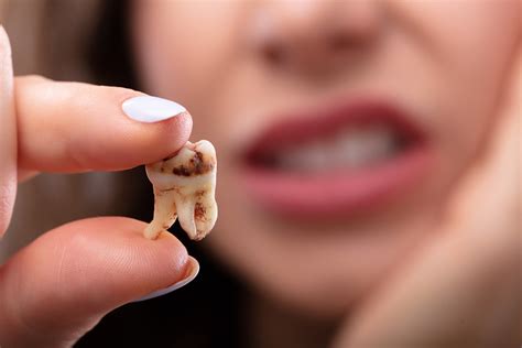 How Does Tooth Decay Develop? | Oral Health | Lovett Dental Heights TX