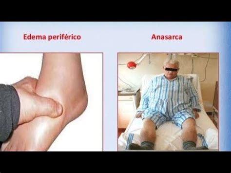 CASE Presentation of ANASARCA / Medicine - YouTube