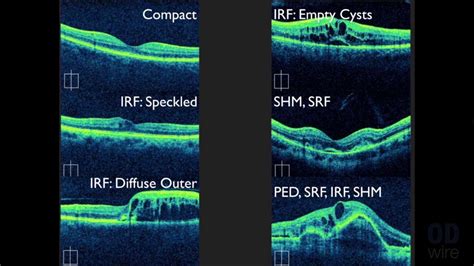 Macular OCT Interpretation: A Practical Discussion with Dr. David E ...