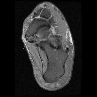 (PDF) Accessory navicular as a cause of medial foot pain:Evaluation ...