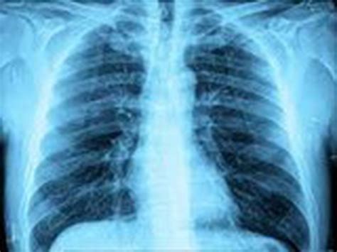 An outbreak of a respiratory illness in northern China and Ohio in the US — the White Lung ...