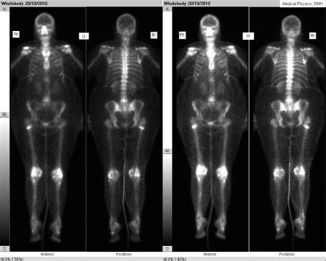 Bone scan showing increase uptake in the right hip. | Download ...