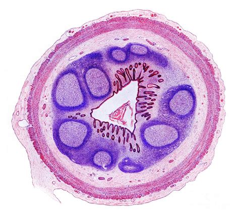 Appendicitis Histology