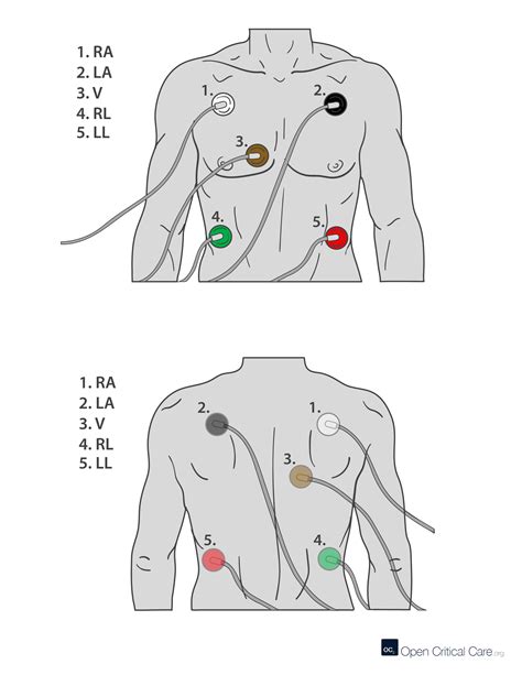 ECG Electrode Placement - Open Critical Care