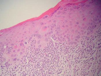 Erythroplakia Histopathology