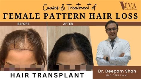 Female Pattern Hair Loss Causes and Treatment by Dr. Deepam Shah - Viva ...