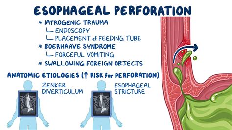 Esophageal perforation: Clinical sciences - Osmosis Video Library