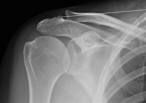 Acromioclavicular Joint (ACJ) Arthritis