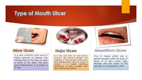 PPT - Treatment of Mouth Ulcer by Must4care PowerPoint Presentation, free download - ID:7768675