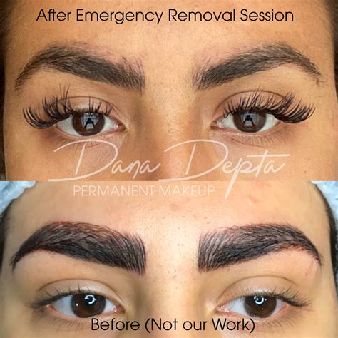 Saline Removal Photos | Dana Depta Permanent Makeup