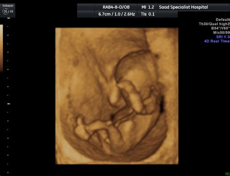 4D Fetal Ultrasound - radRounds Radiology Network