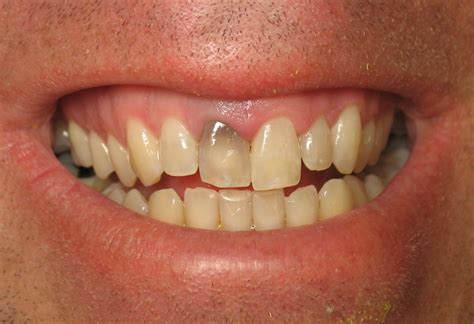 Tooth Whitening – Important Things to Know | Centre For Healthy Aging