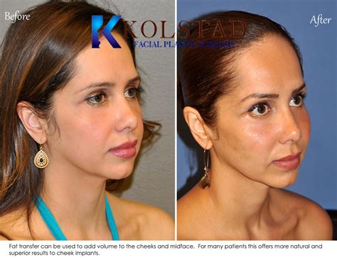 Facial Fat Transfer Before & After Gallery | Dr. Kolstad - San Diego ...