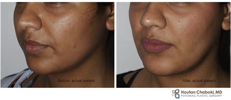 Sculpting the Face with Buccal Fat Reduction