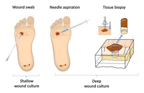 Wound Culture - Swabs, Biopsies, Needle Aspiration