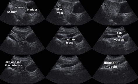 Pocket Gyn | Prof. Tutschek I Pränatal Zürich I fetal.ch