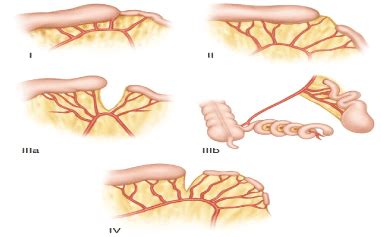 Dual Type (Type I, Type IIIa) Ileal Atresia with Minor Omphalocele